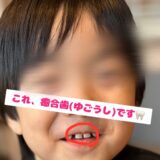 長男の癒合歯について